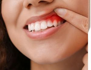 Press release image for Thorncrest Dental Brings Advanced Laser Dentistry to Etobicoke with Picasso Soft Tissue Laser