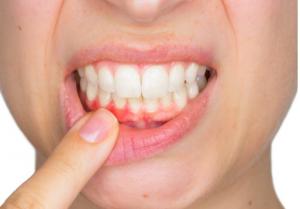 Press release image for Bronte Road Family Dental Introduces Picasso Soft Tissue Laser Technology for Enhanced Patient Care