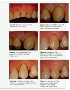 Press release image for Predictable Treatment of Stubborn Abfraction Lesions by Oakville Dentist