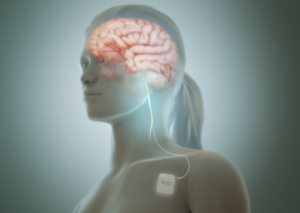Press release image for Top Vagus Nerve Stimulation Devices Research Report (2026) Published by OSHF