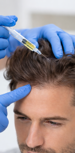 Press release image for Dutasteride Mesotherapy Now Available for Hair Loss Treatment in Kitchener-Waterloo at True North Metabolic